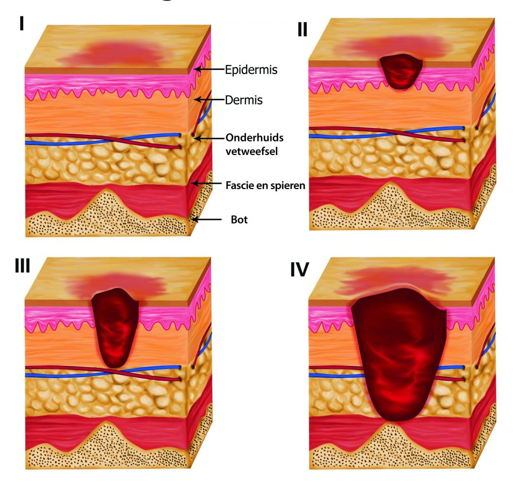 4 dwarsdoorsnedes van de huid met stadia van decubitus